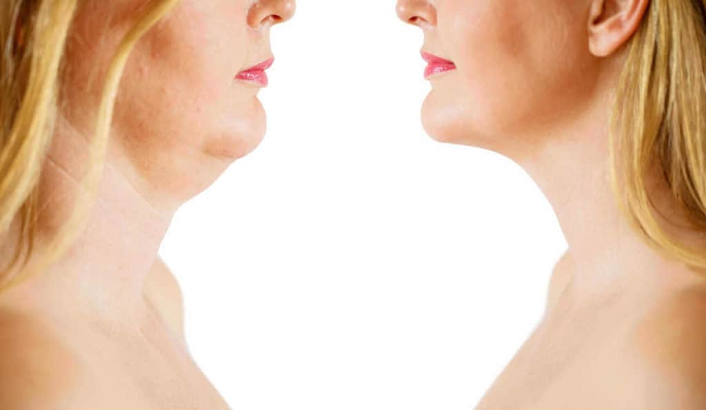 Double Chin treatment World's End before and after results