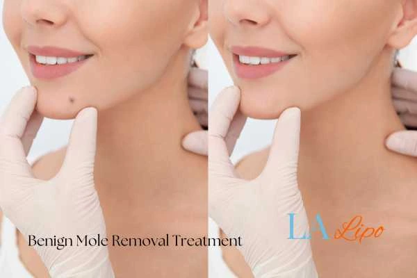 woman's before and after mole removal World's End results