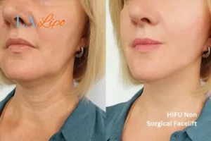 hi-fu for wrinkles World's End before and after results