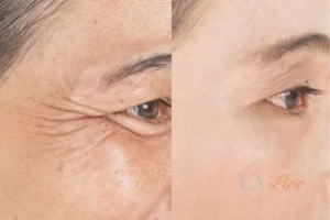Before and after results of woman - HI-fu wrinkles reduction treatment World's End