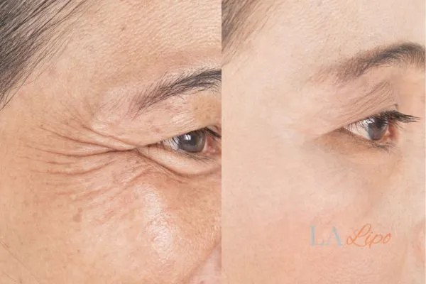 Before and after results of woman - HI-fu wrinkles reduction treatment World's End
