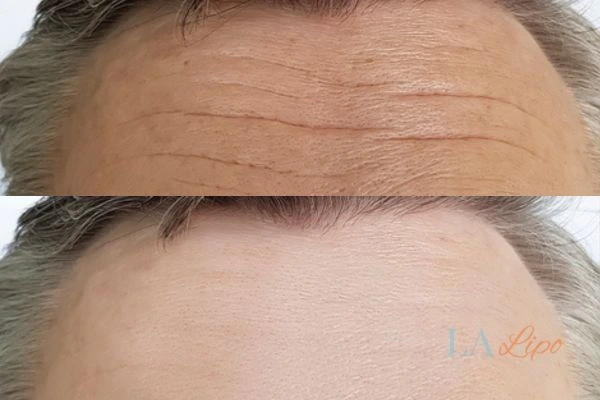results of HIFU World's End on mans forehead to help reduce lines and wrinkles
