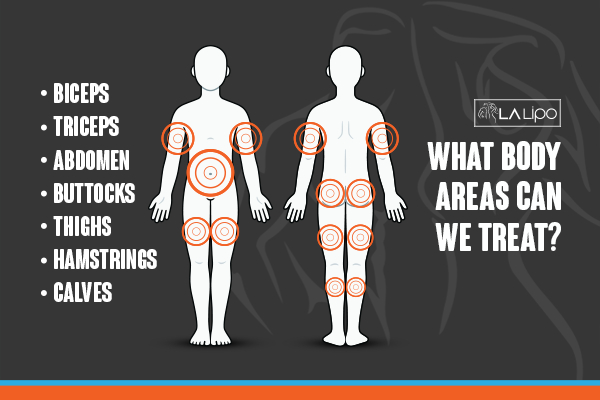 Graphic to show areas you can have LA-EMS Body Sculpting World's End treatment.