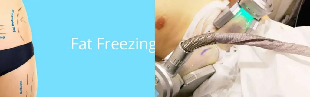 multi areas of a persons body having coolsculpting World's End treatment
