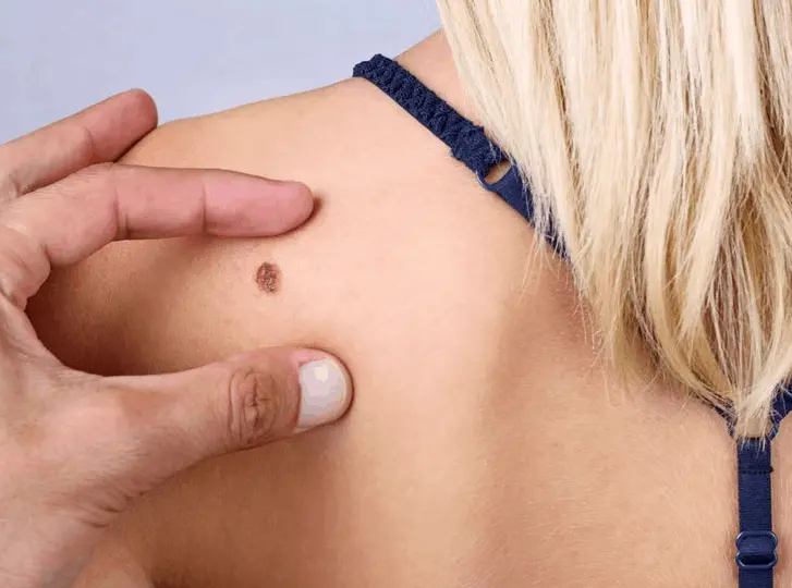woman having mole removal World's End consultation before treatment.