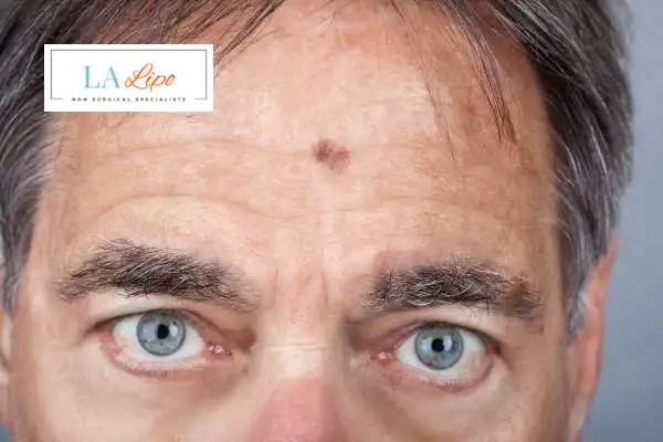 Solar Lentigo Removal World's End image of man with mark on his forehead