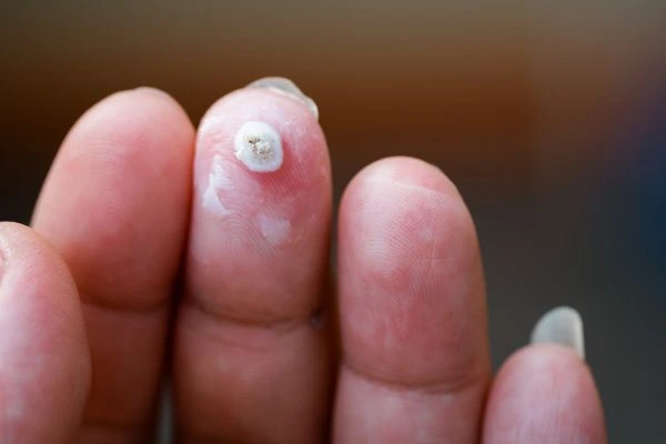 wart on person finger - cryotherapy to treat from LA LIPO World's End