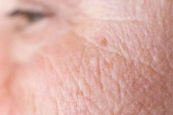 close up picture of a woman's face showing an age spot World's End
