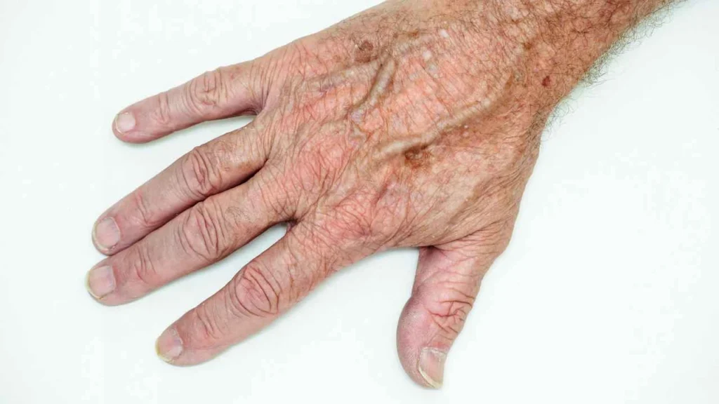 Male hand showing age spot World's End