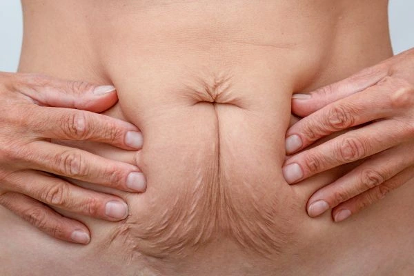 Should I Combine Diastasis Recti Treatment with Body Contouring for Better Results World's End?