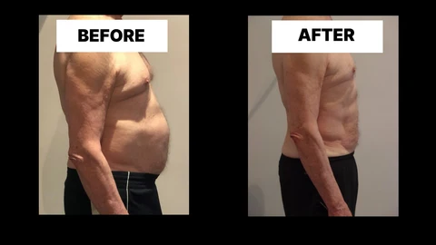 What Symptoms Can Diastasis Recti Cause in Men? Weak Core, Back Pain and Poor Posture World's End